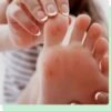 Ingrown Wart Removal South Amboy